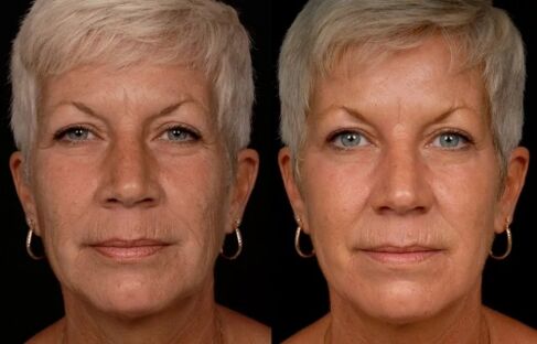 The result of laser treatment of the facial skin - reduction of wrinkles